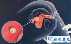 人工授精失败了，可能是内膜惹的祸